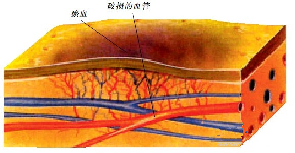 淤血剖面图